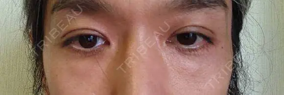 クマ治療 / 下まぶたたるみ取り / 下まぶたの脂肪取り セオリークリニック BEFORE メイン用