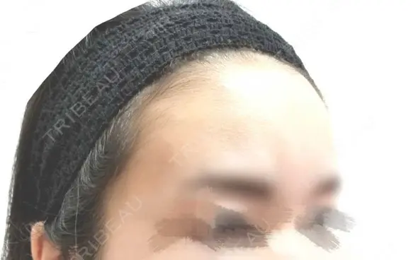 額を丸く クリニックビューティー恵比寿 BEFORE メイン用
