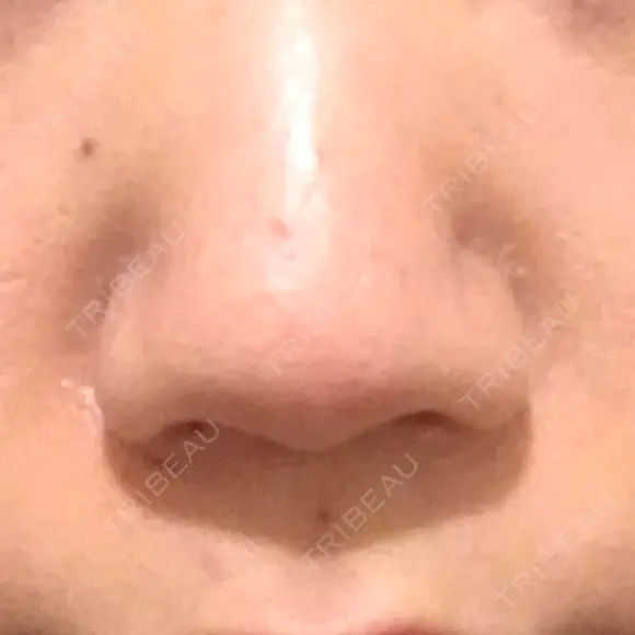 鼻尖形成（切開） / 小鼻縮小（切開） / 軟骨移植 牧野皮膚科医院 BEFORE メイン用