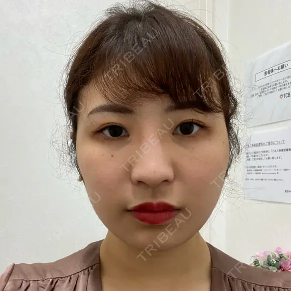 エレクトロポレーション / 毛穴洗浄（ハイドラフェイシャルなど） スキンシアクリニック BEFORE メイン用