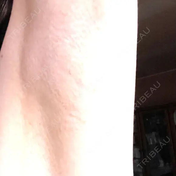 ワキ汗治療（ボトックス） Mare beauty clinic BEFORE メイン用