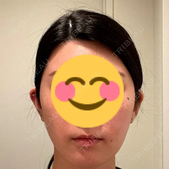 アートメイク（唇） LEAGRANT CLINIC 中目黒 BEFORE メイン用