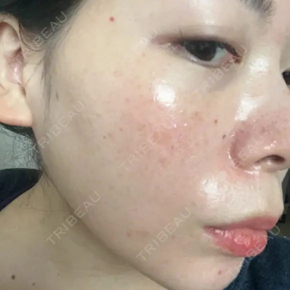 光治療（フォトフェイシャルなど） LETICIA CLINIC（レティシア クリニック） BEFORE メイン用