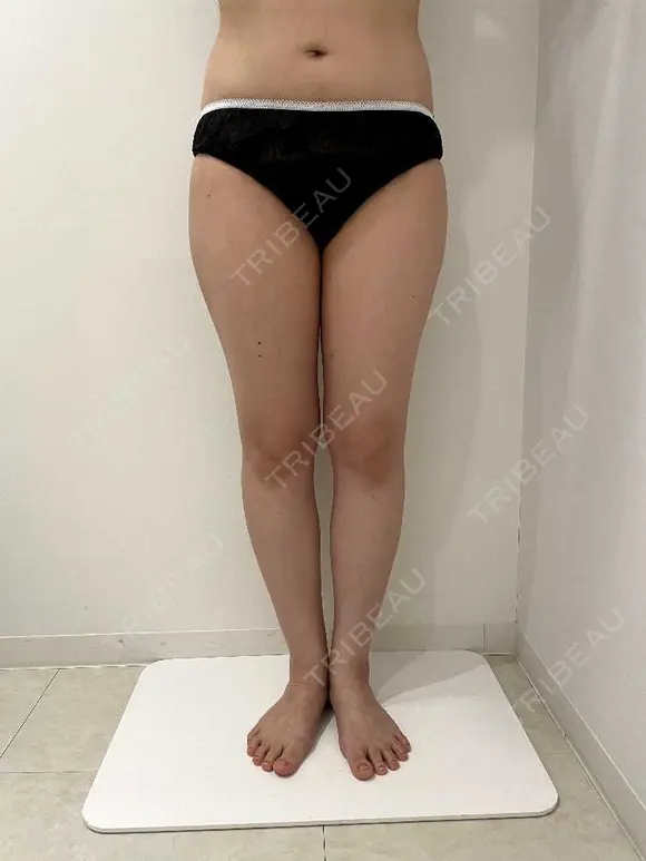 脂肪吸引（脚） / インディバ（脚） 藤・ナチュレ美容クリニック 恵比寿院 BEFORE メイン用