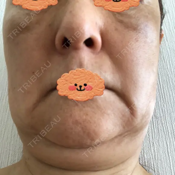 脂肪吸引（顔） / 脂肪注入（額） / 切開リフト 札幌ル・トロワ ビューティクリニックVogue BEFORE メイン用