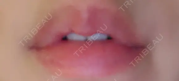 ヒアルロン酸注入（唇） 宇都宮竹内クリニック BEFORE メイン用