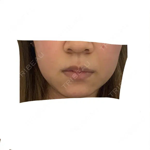 ボトックス（口角） / その他（口元） 表参道スキンクリニック 名古屋院（DAILY SKIN CLINIC提携院） BEFORE メイン用