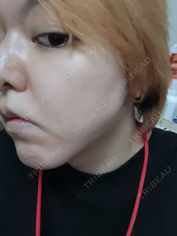 シミ取りレーザー PICO BEAUTY CLINIC BEFORE メイン用