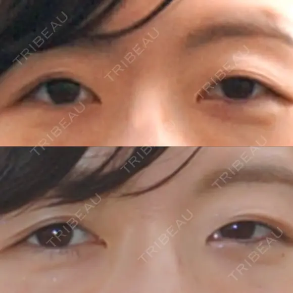 二重切開 城本クリニック 長崎院 BEFORE メイン用