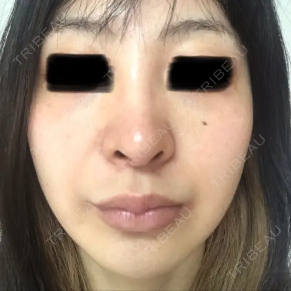 ピコレーザートーニング（美白・肝斑） B-LINE CLINIC 池袋院 BEFORE メイン用