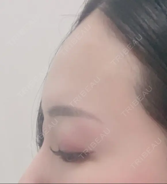肌ヒアルロン酸注入（たるみ・シワ改善） 湘南美容クリニック 宇都宮院 BEFORE メイン用