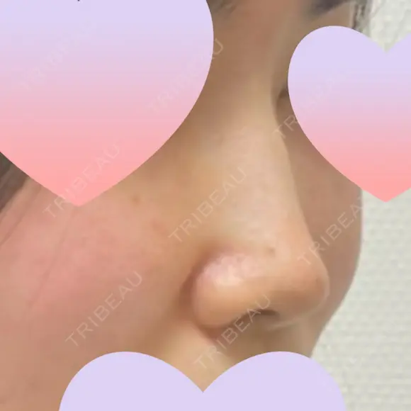 隆鼻術 / 鼻尖形成（切開） / 鼻中隔延長（切開） / 軟骨移植 / 骨切幅寄せ / 真皮移植 表参道スキンクリニック 大阪院 BEFORE メイン用