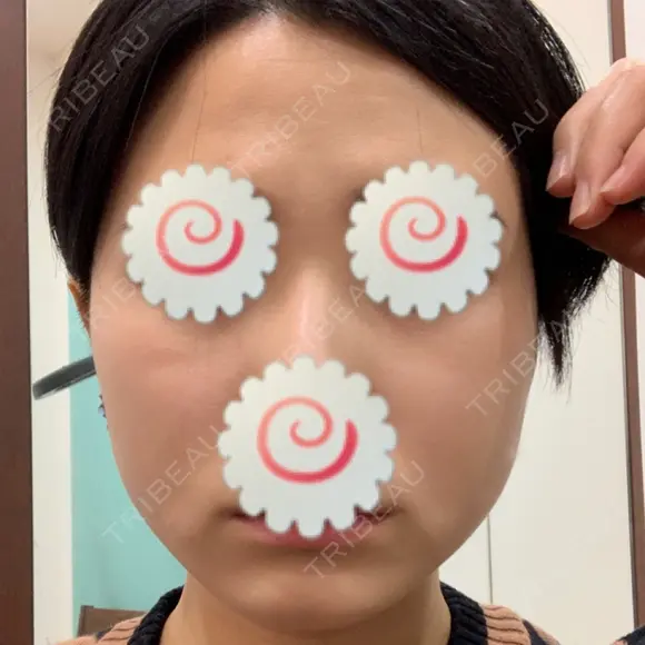脂肪溶解注射（顔） 聖心美容クリニック 福岡院 BEFORE メイン用
