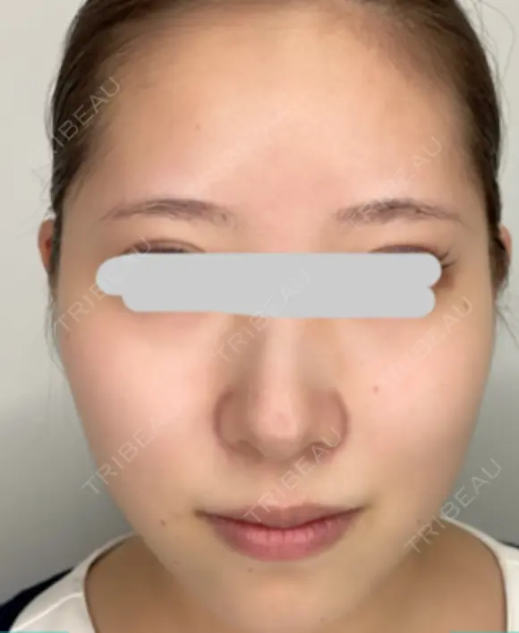 糸リフト / 脂肪吸引（顔） / ジョールファット除去 アリエル美容クリニック 大宮院 BEFORE メイン用