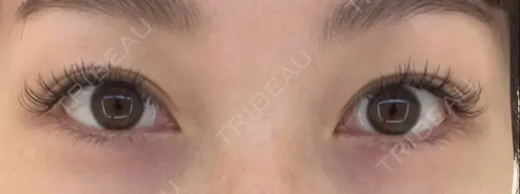 二重埋没 アリエル美容クリニック 大宮院 BEFORE メイン用