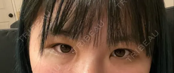 脂肪吸引（顔） / 上まぶたの脂肪取り / 下まぶたの脂肪取り / 眉下切開 LIKI CLINIC KOBE BEFORE メイン用