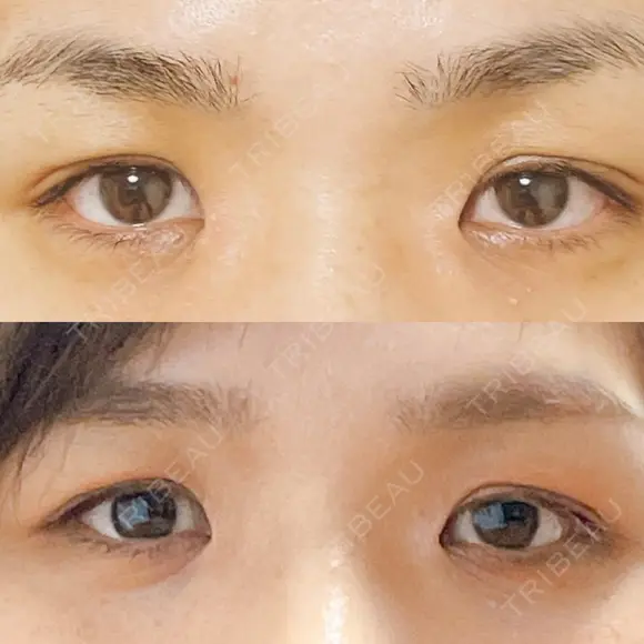 目頭切開 / 上まぶたの脂肪取り / 眉下切開 e:Top clinic（イートップクリニック） BEFORE メイン用