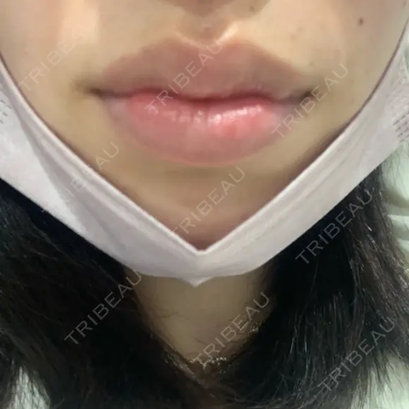 口唇縮小術 / ヒアルロン酸注入（頬） B-LINE CLINIC 池袋院 BEFORE メイン用