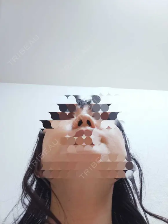 鼻尖形成（切開） / 鼻尖縮小 / ヒアルロン酸注入（鼻） 東京形成美容外科 船橋院 BEFORE メイン用