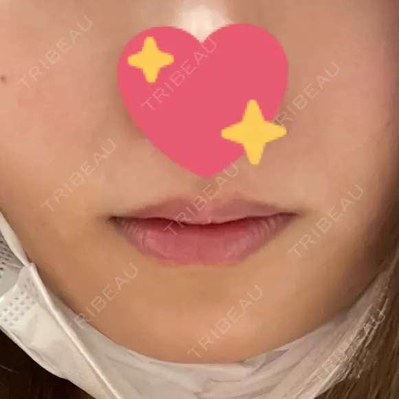 ヒアルロン酸注入（唇） ルラ美容クリニック 渋谷本院 BEFORE メイン用