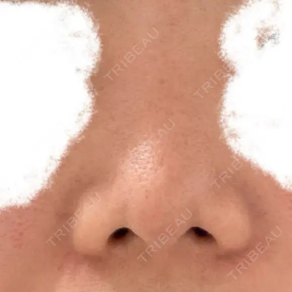 隆鼻術 / 軟骨移植 フェアクリニック川口 BEFORE メイン用