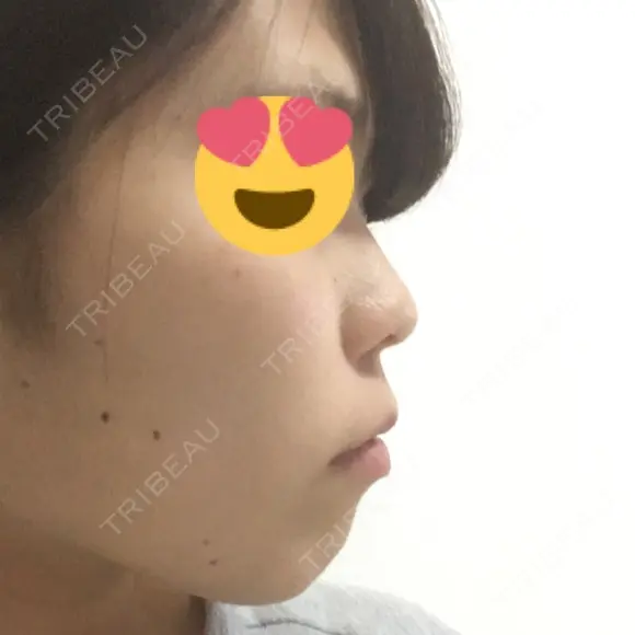 スレッドノーズ / ヒアルロン酸注入（鼻） / ヒアルロン酸注入（あご） / ヒアルロン酸注入（額） キップン整形外科 BEFORE メイン用