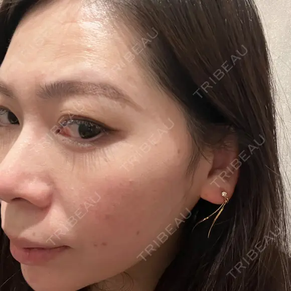 アートメイク（ほくろ） oneUPclinic BEFORE メイン用