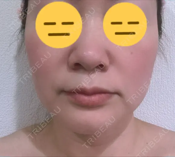 糸リフト / 脂肪吸引（顔） / ボトックス（エラ・小顔） 銀座マイアミ美容外科 BEFORE メイン用