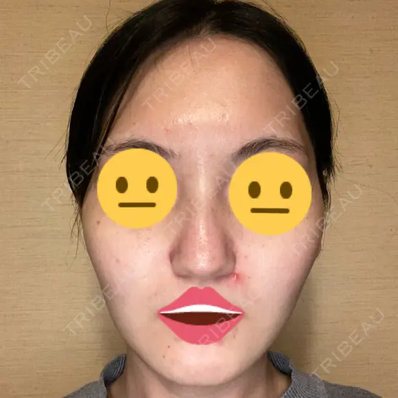 ピーリング（ニキビ・毛穴） 品川美容外科 福岡院 BEFORE メイン用