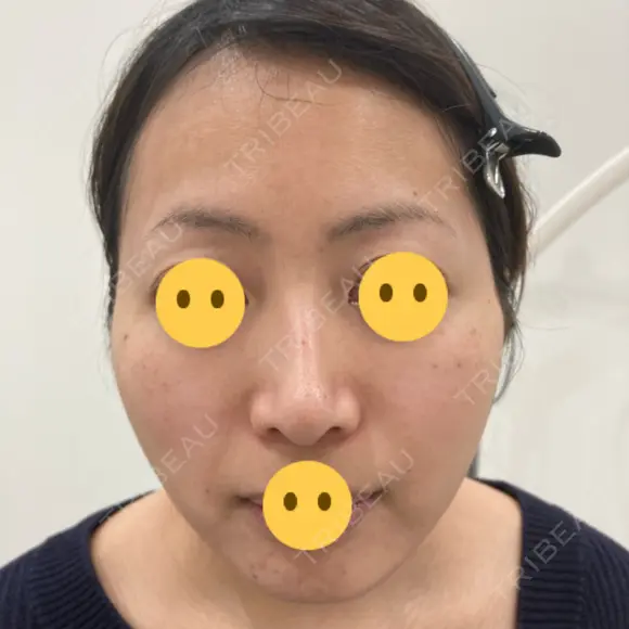 ヴェルヴェットスキン アリエル美容クリニック 大宮院 BEFORE メイン用