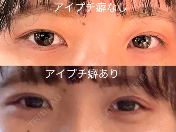 二重埋没 水の森美容クリニック 東京新宿院 BEFORE メイン用