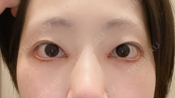 二重埋没 湘南美容クリニック 辻堂アカデミア BEFORE メイン用