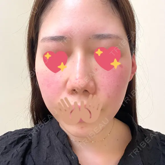 ヴェルヴェットスキン 表参道スキンクリニック 名古屋院（DAILY SKIN CLINIC提携院） BEFORE メイン用