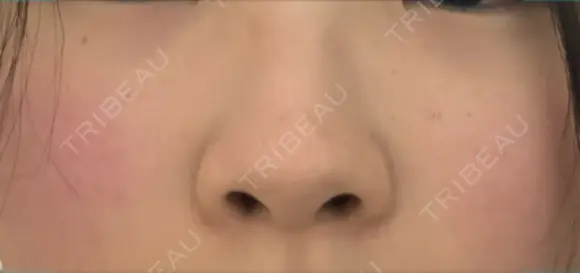 小鼻縮小（切開） JUN CLINIC BEFORE メイン用