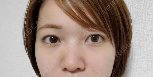 鼻尖形成（切開） / 鼻中隔延長（切開） / クマ治療 / 軟骨移植 R Beauty CLINIC 銀座院 BEFORE メイン用