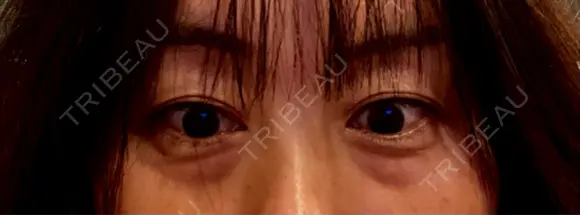 下まぶたの脂肪取り / ボトックス（目尻） TCB東京中央美容外科 町田院 BEFORE メイン用