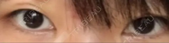 二重切開 医療法人河田外科形成外科 BEFORE メイン用