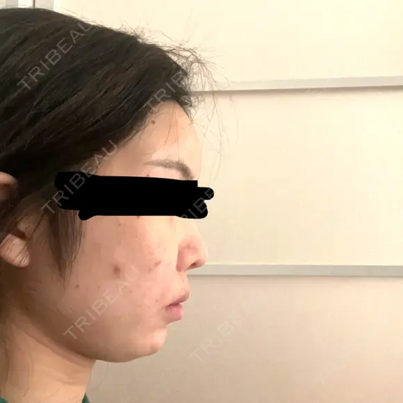 脂肪注入（肌） ヴェルトラクリニック 大阪院 BEFORE メイン用