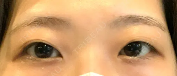 二重切開 / その他（目元） LIKI CLINIC KOBE BEFORE メイン用