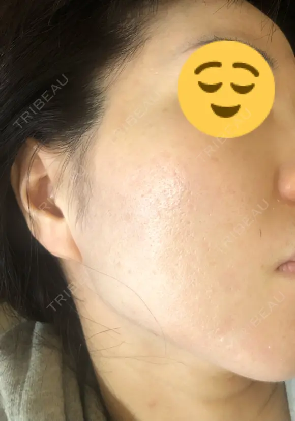 ヴァンパイアフェイシャル 大阪TAクリニック BEFORE メイン用