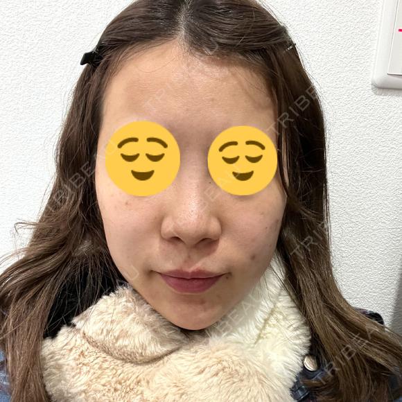 鼻尖形成（切開） / 小鼻縮小（切開） / その他（鼻） YBC横浜美容外科 大宮院 BEFORE メイン用