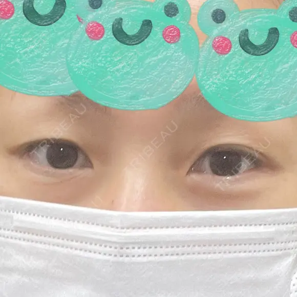 二重切開 / 眼瞼下垂（切開） 湘南美容クリニック Regno 銀座院 BEFORE メイン用