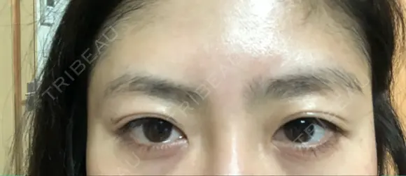 二重埋没 湘南美容クリニック 品川院 BEFORE メイン用