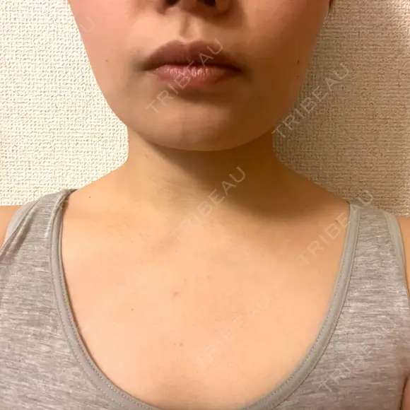 ボトックス（首） KOBE美容皮膚科 西宮院 BEFORE メイン用