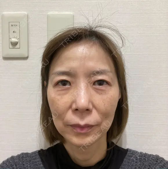 糸リフト / クマ治療 / 下まぶたたるみ取り / 下まぶたの脂肪取り / 眉下切開 / 脂肪注入（額） 銀座みゆき通り美容外科 東京本院 BEFORE メイン用
