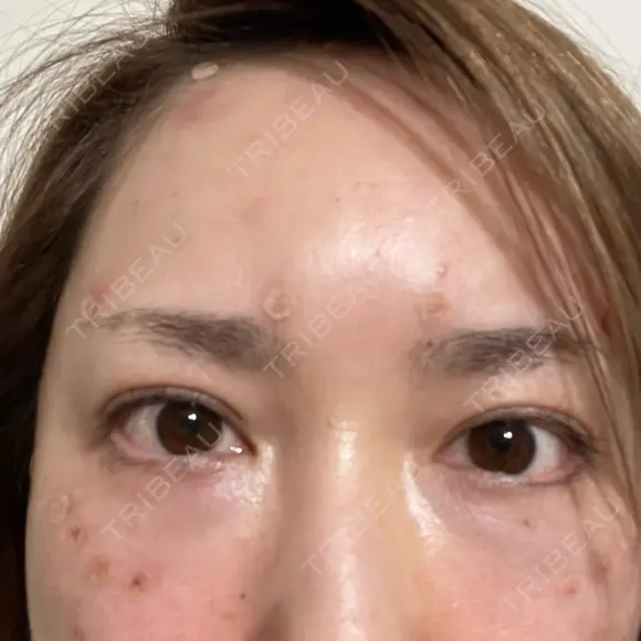 クマ治療 / 脂肪注入（額） 銀座みゆき通り美容外科 東京本院 BEFORE メイン用