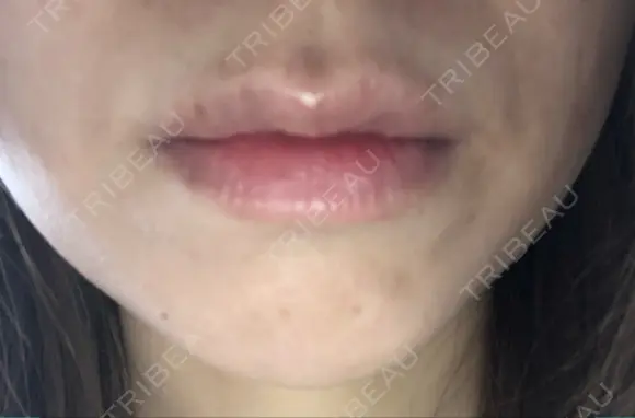 ボトックス（あご） / ボトックス（エラ・小顔） / ヒアルロン酸注入（唇） / ボトックス（口角） / ボトックス（人中） アリエル美容クリニック 大宮院 BEFORE メイン用