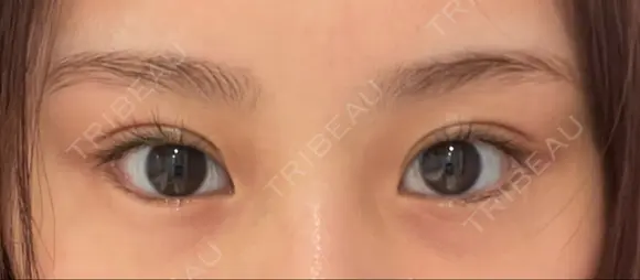 目尻靭帯移動 R.O.clinic BEFORE メイン用