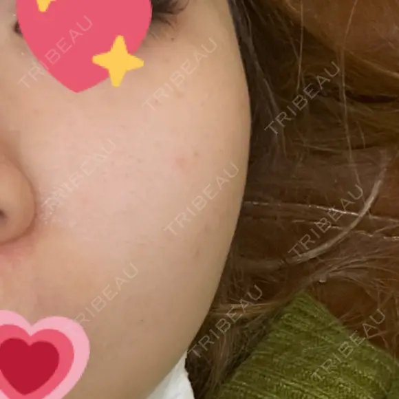 光治療（フォトフェイシャルなど） / ピーリング（ハリ・ツヤ） AURORA CLINIC（オーロラクリニック）新宿院 BEFORE メイン用