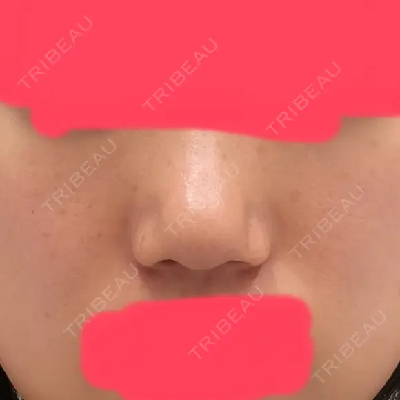 ヒアルロン酸注入（鼻） 東京美容外科 銀座院 BEFORE メイン用